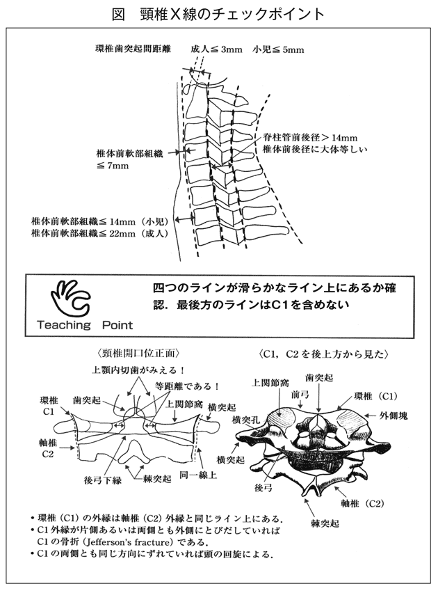 骨折 ジェファーソン