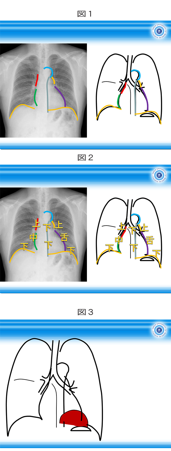 胸部X線ルネッサンス（上）[診内研より495] - 医科 - 学術・研究