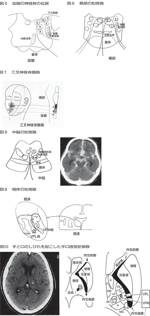 梗塞 延髄